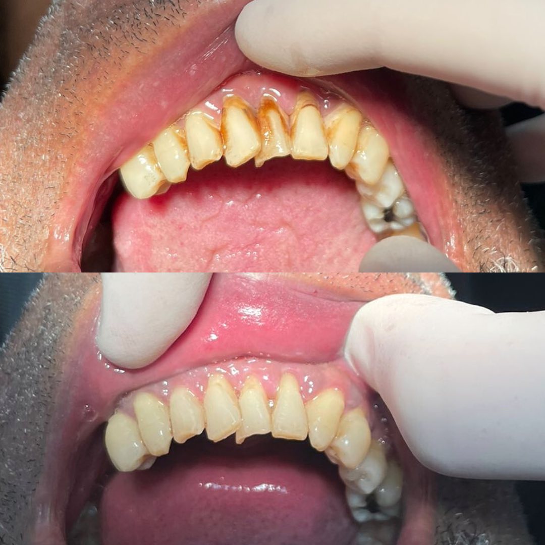 Fechamento de Diastema com Resina — antes e depois